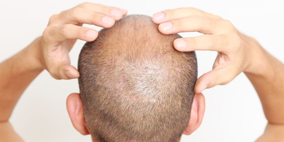 Three months after a hair transplant