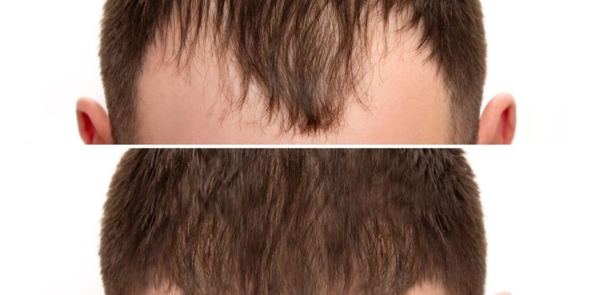 Hair transplant after ten years