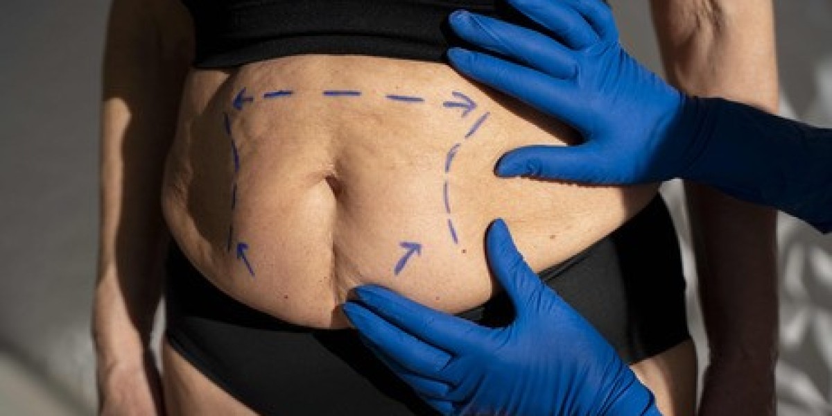 Sculpting Your Dream Body: Expert Guide to Tummy Tuck Surgery in Punjab