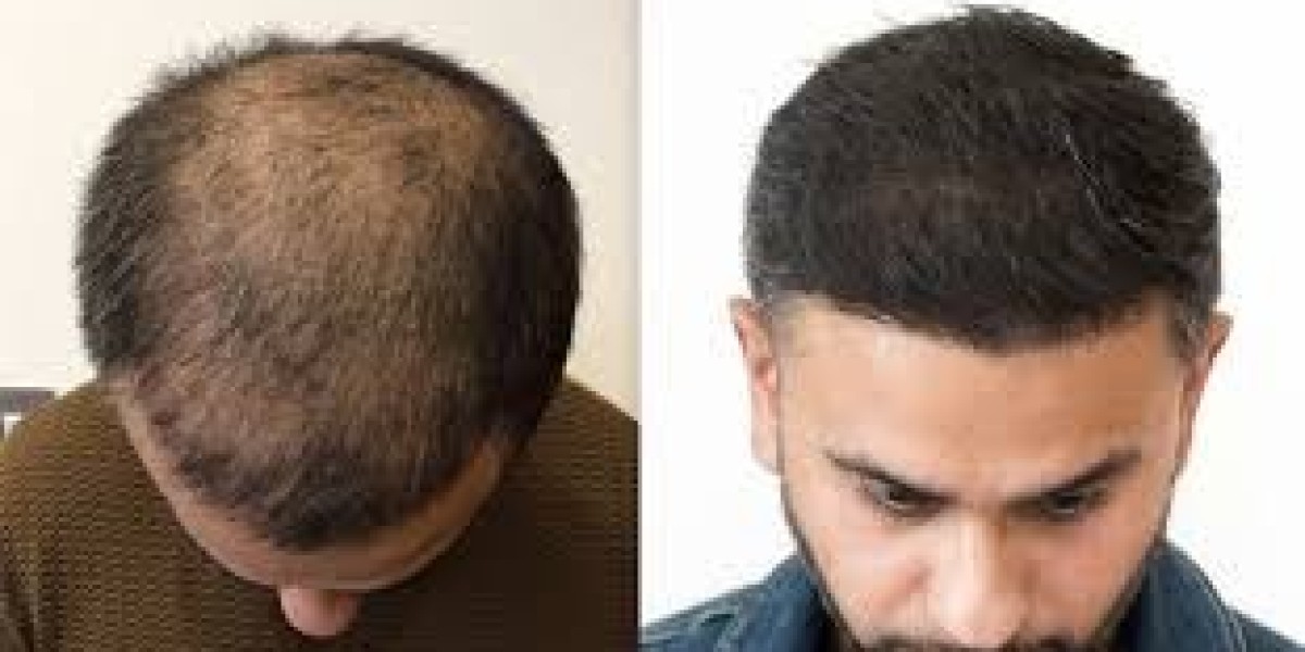 Is hair restoration the best treatment for genetic baldness?