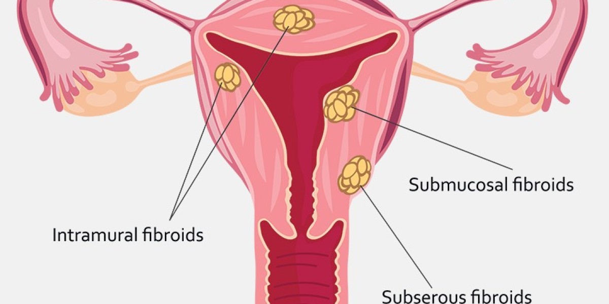 Understanding Fibroid Surgery: A Key to Women’s Health