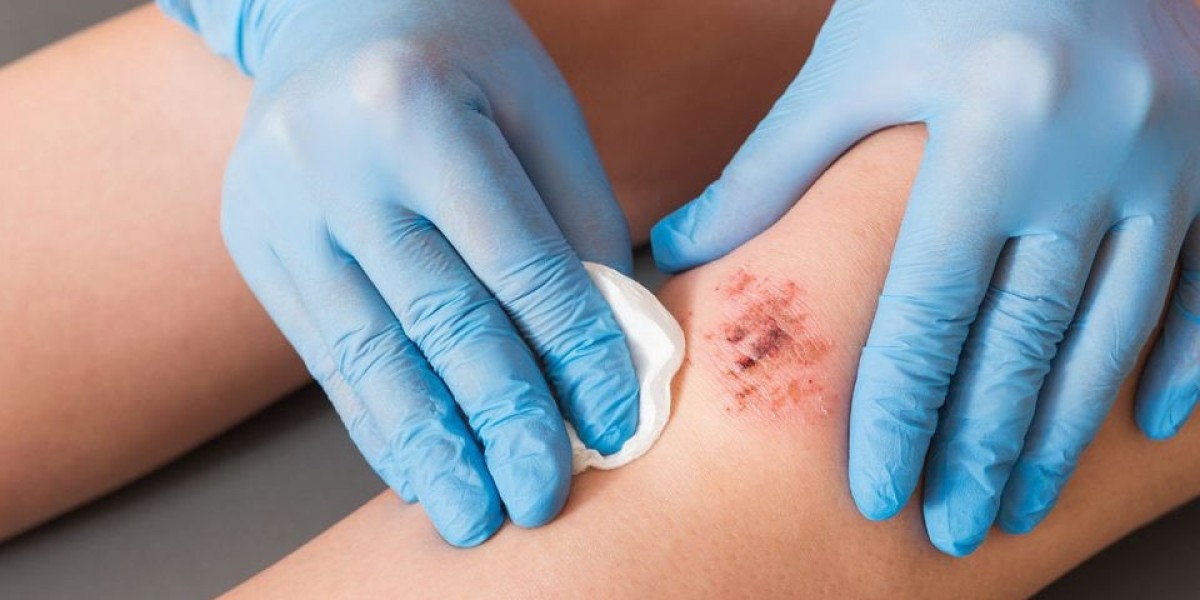 Wound Healing Market Size, Industry Analysis Report 2023-2032 Globally