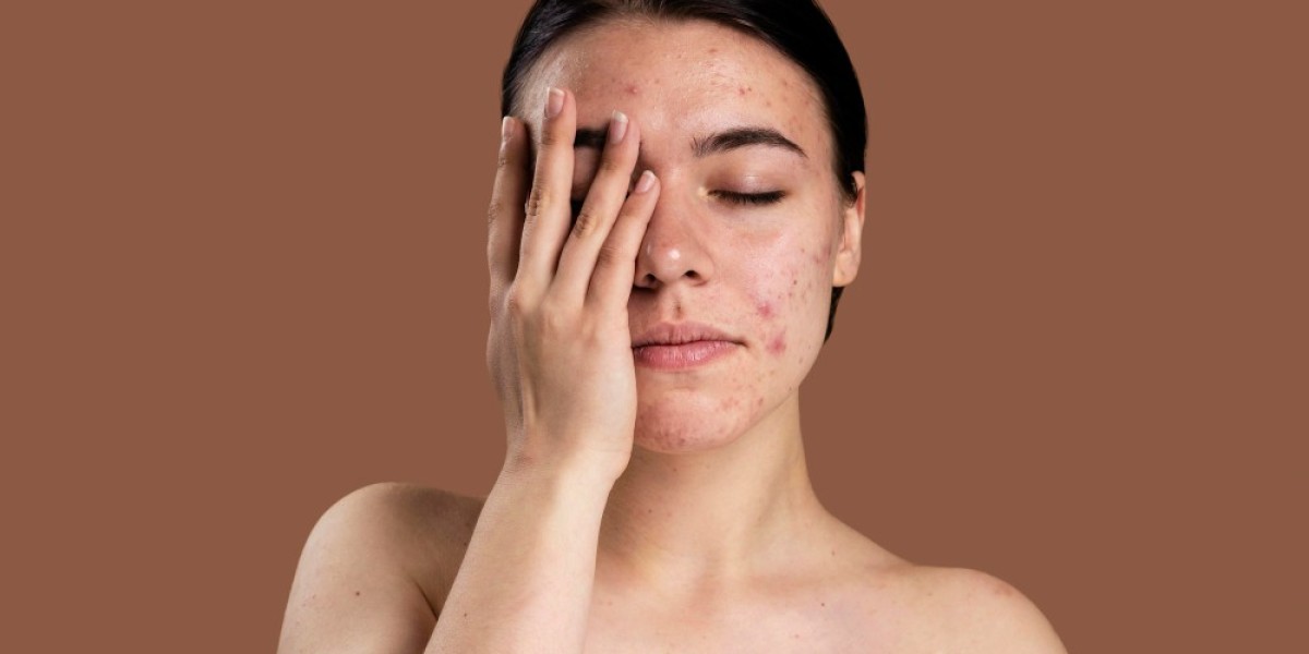 Homeopathy or Allopathy: Which Is Better for Acne?