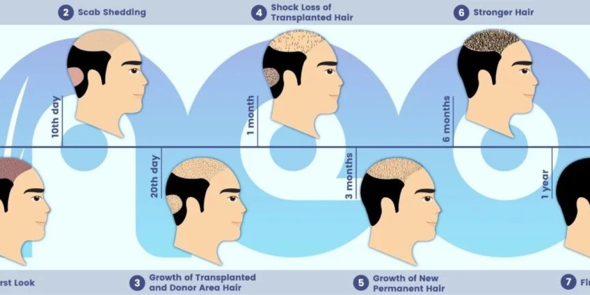 Hair Replacement Surgery in Turkey: The Ultimate Solution for Hair Restoration