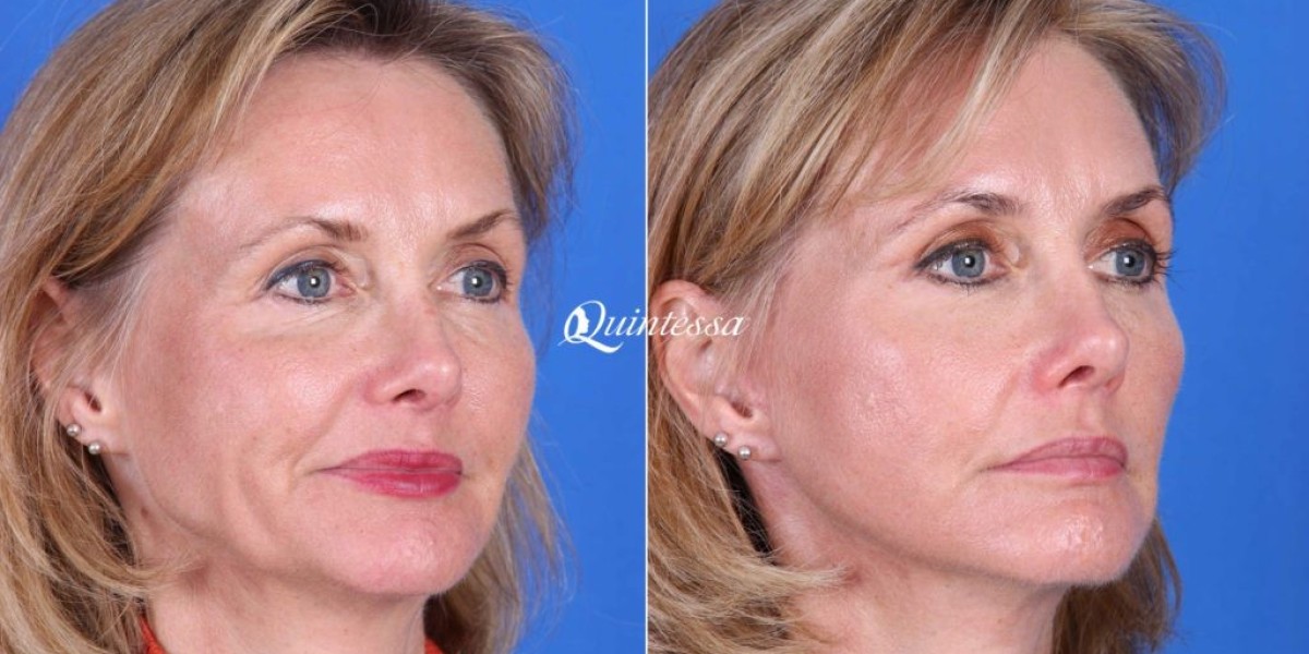 Eyelid Surgery in Fort Myers: Enhancing Your Look and Confidence