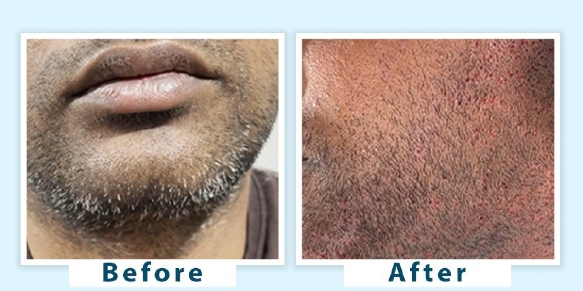 Best Dermatologists for Grey Beard Treatment in Delhi Expert Care and Solutions