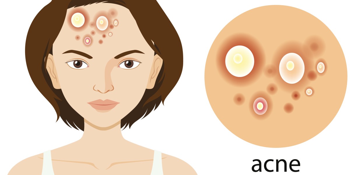 Say Goodbye to Acne with Homeopathy Treatment at Dharma Homoeopathy