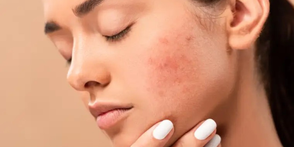 Best Modern Solutions for Acne Scarring