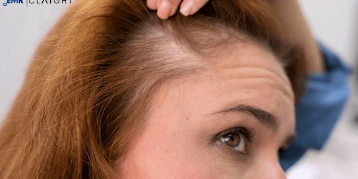 Global Alopecia Market Trends, Growth, & Future Outlook | 2034