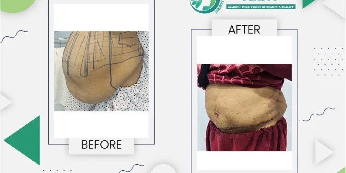 Affordable Tummy Tuck in Lahore: Finding Quality Care