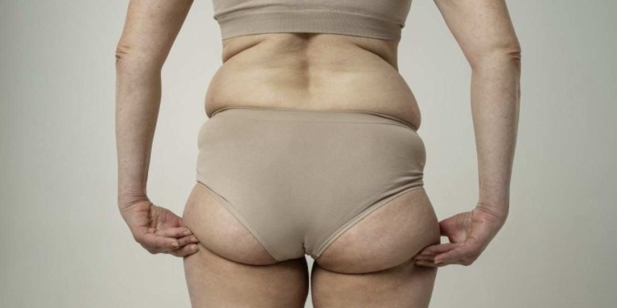 Lipedema Liposuction