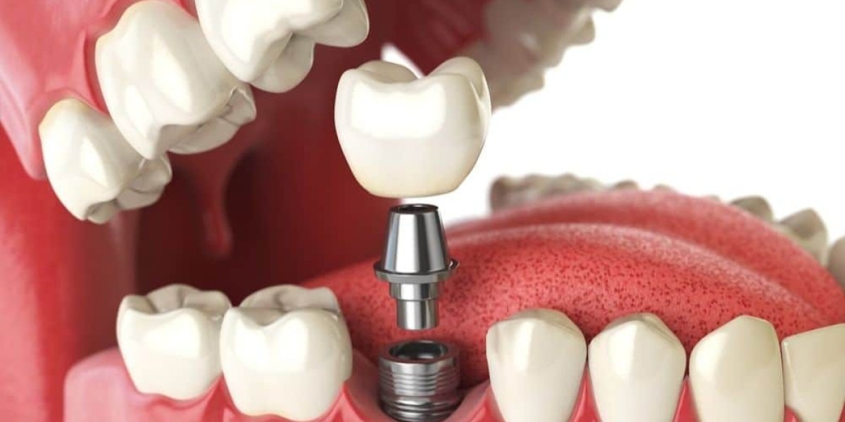 Can I get a single implant immediately after tooth extraction?