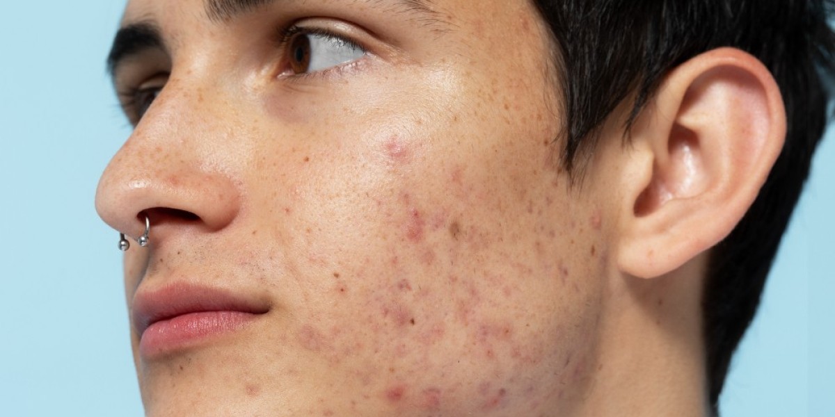 Which Treatment Is Best for Acne: Homeopathy or Allopathy?