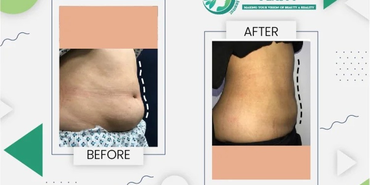 Liposuction Cost in Pakistan: Affordable Body Contouring Options for 2025