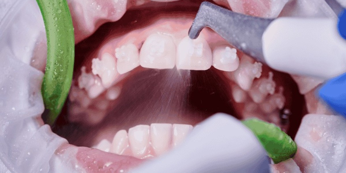 The Importance of Regular Teeth Cleaning for Oral Health