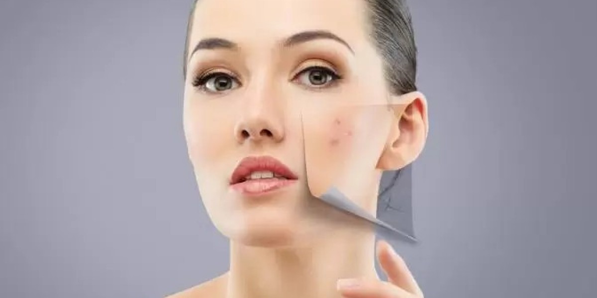 What is best for Face Acne?